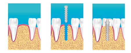 Implant dentaire à Maison-Alfort (94)